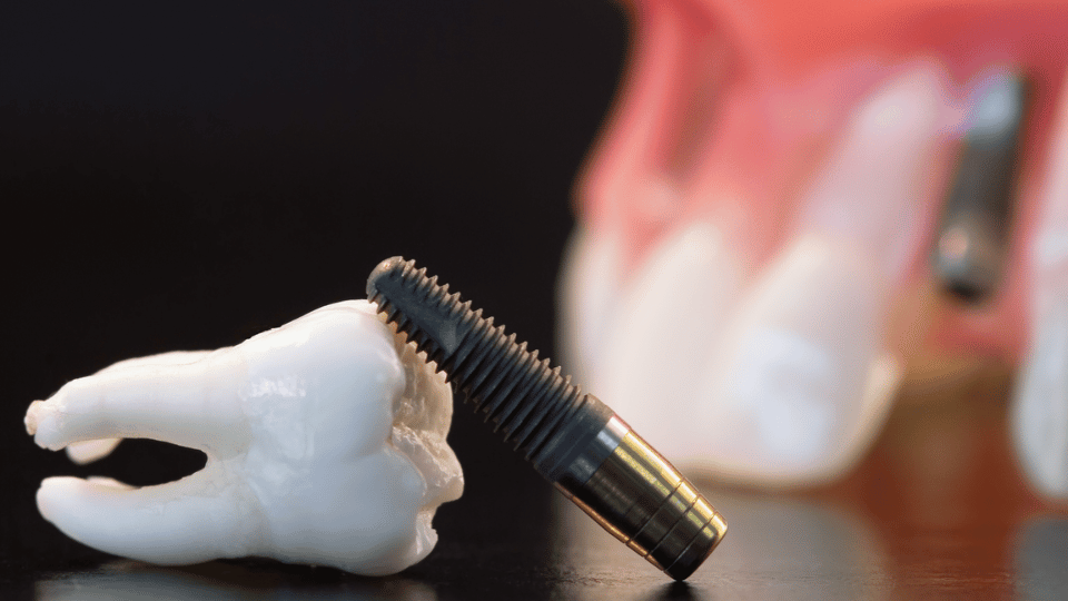 Dental implants service in manchester, ct firstline dental