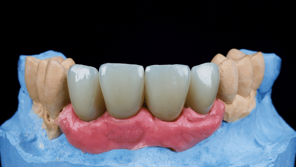 dental crowns in manchester ct
